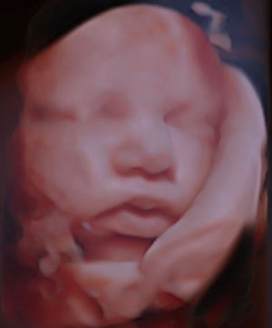Silhouette Imaging ultrasound