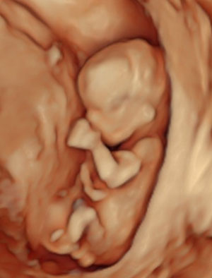 Silhouette Imaging ultrasound