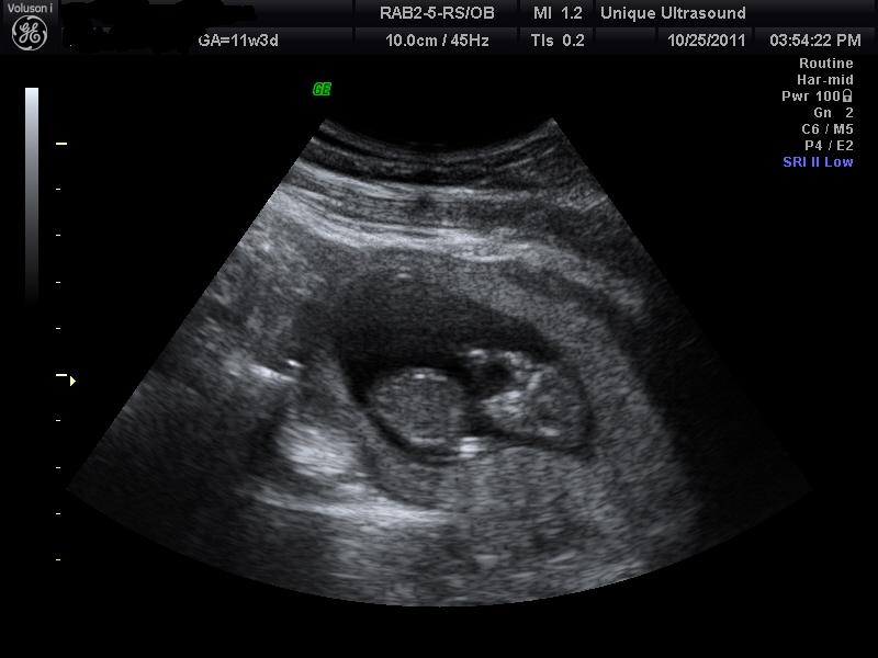 A 5-10 minute 2d ultrasound done at 13 weeks. 